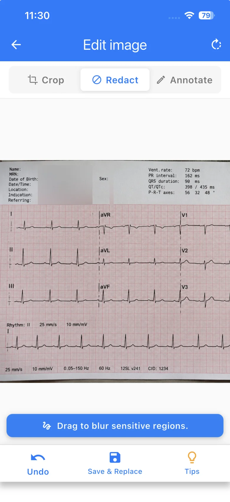 Redaction tool in EMMS blurring the patient name, MRN and date of birth on an ECG printout, with the clinical measurements left readable